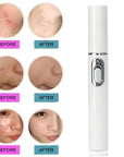 Blue Light Therapy Acne Laser Pen