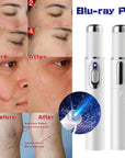 Blue Light Therapy Acne Laser Pen